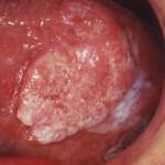 Consequences of mucositis