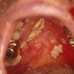 Consequences of mucositis