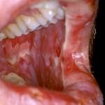 Consequences of mucositis