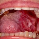 Consequences of mucositis