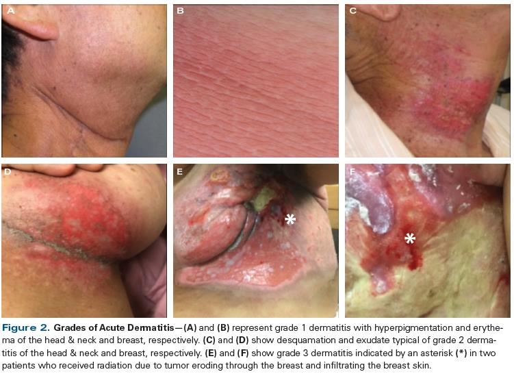 Grades of Acute Dermatitis