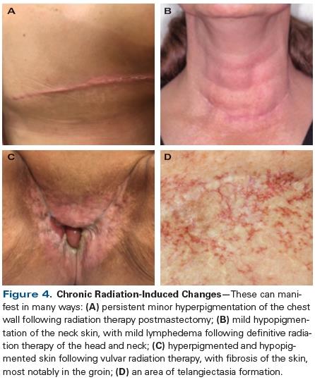Chronic Radiation-Induced Changes